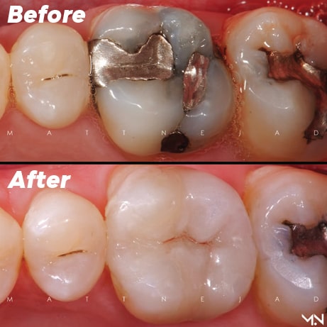 Silver filling is replaced with a natural biomimetic restoration.