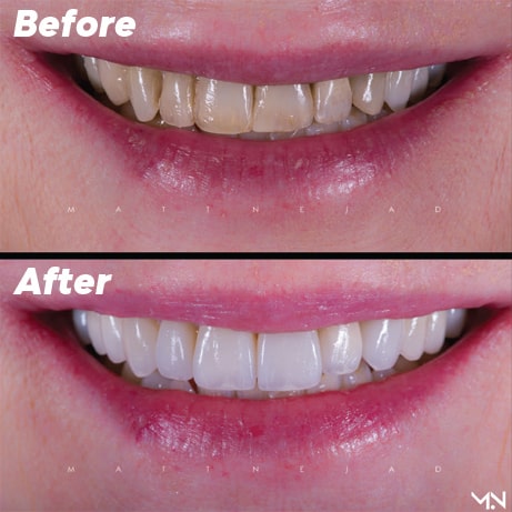 Before and after Biomimetic Smile makeover with natural, conservative, porcelain veneers.
